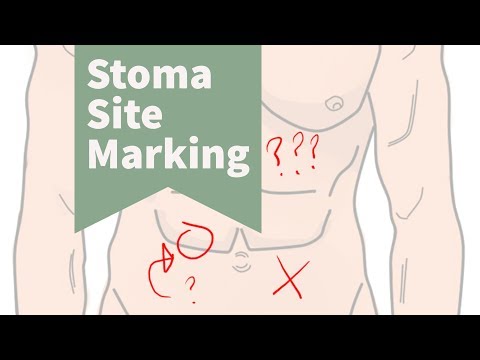 The Importance of Stoma Site Marking