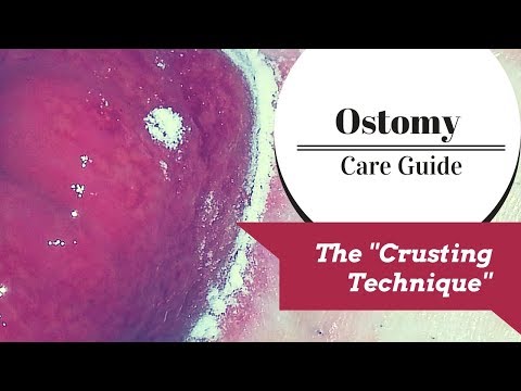 The Ostomy Crusting Technique Explained!