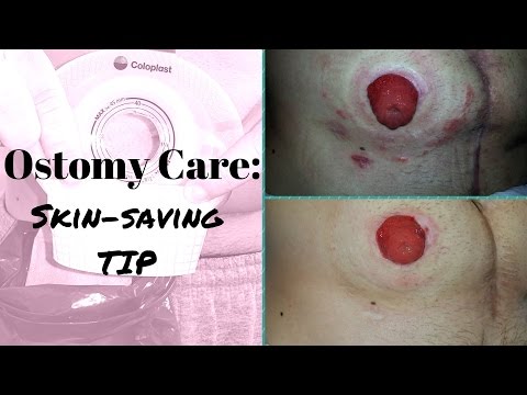 Ostomy Care Tip: Saving your skin from abrasion