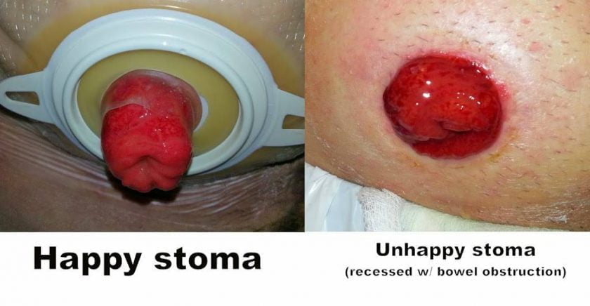 Happy-vs-unhappy-stoma