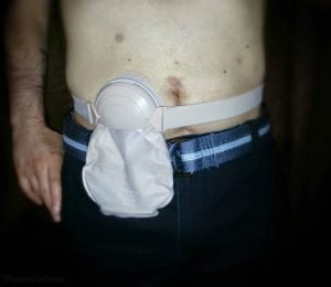 Stoma guard over shorts front view