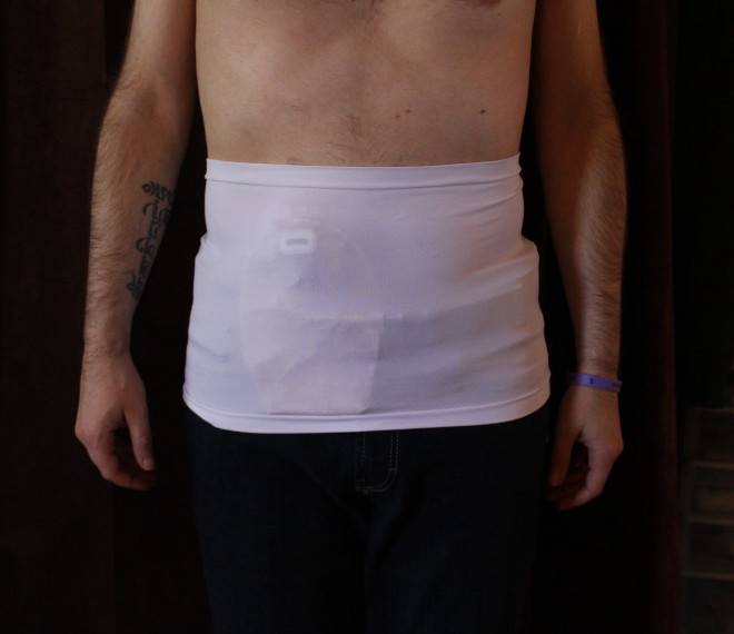 Ostomy Hacks Dressing with an Ostomy  Shield HealthCare