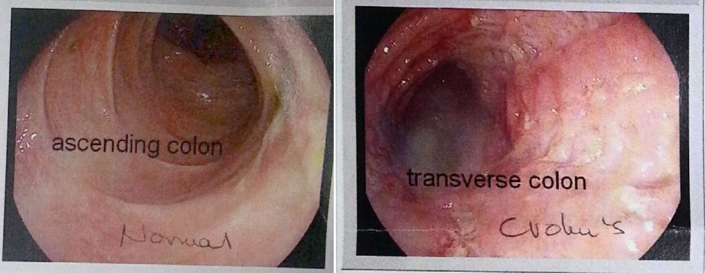 Crohn's colonoscopy photos
