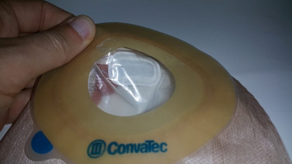 Ostomy Pouch Ballooning | VeganOstomy