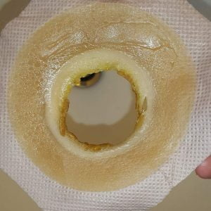 Ostomy wafer with lots of erosion