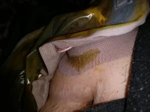 Stoma Pro final leak