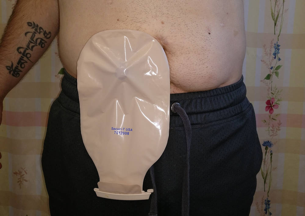 wearing the Securi-t_1PC-extended-wear ostomy appliance-small