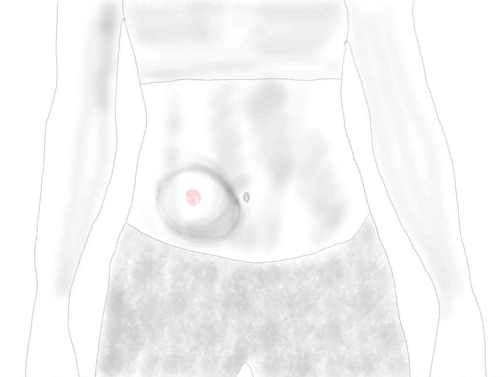 Parastoma hernia from front