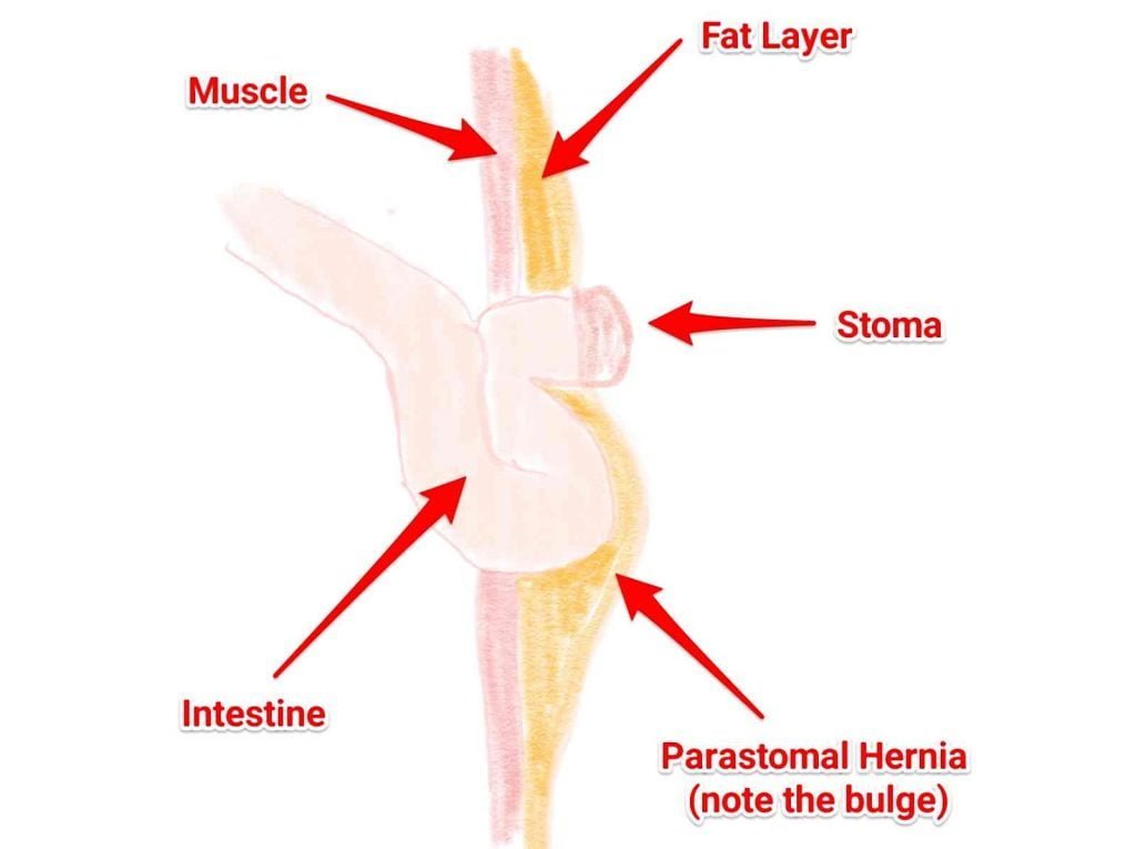 Parastomal Hernia_side view