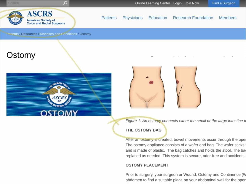 Colon and rectal surgeons mention ostomy bag