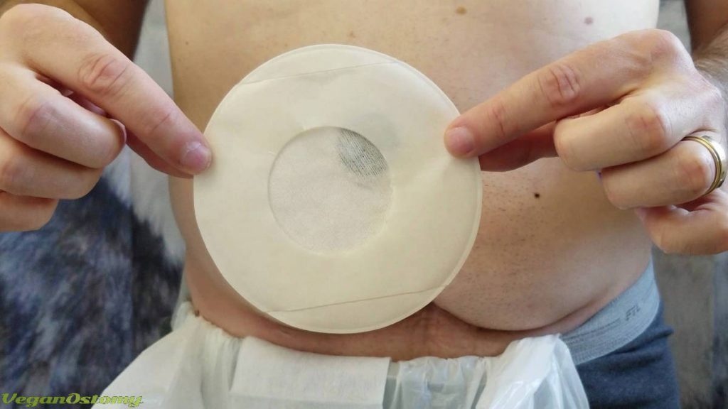 Putting on a stoma cap step 2